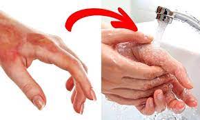 bỏng nước sôi 
